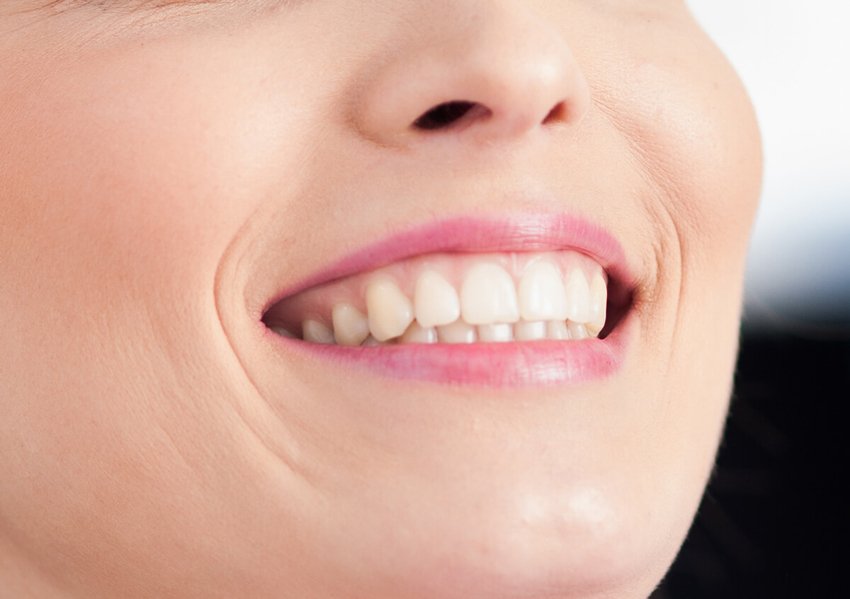 Teeth Whitening at Excel Dental Near Me Springfield Area