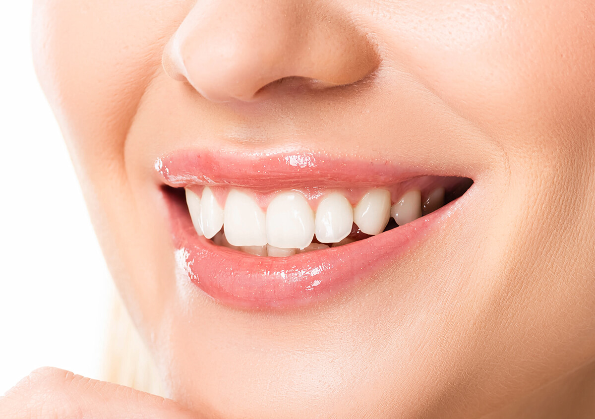Cosmetic Teeth Veneers in Ozark MO Area