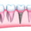 Excel Dental Offers Dental Implants to Replace Missing Teeth